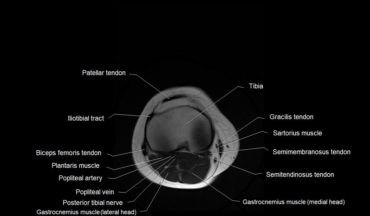 MRI thigh cross sectional anatomy image 60.webp